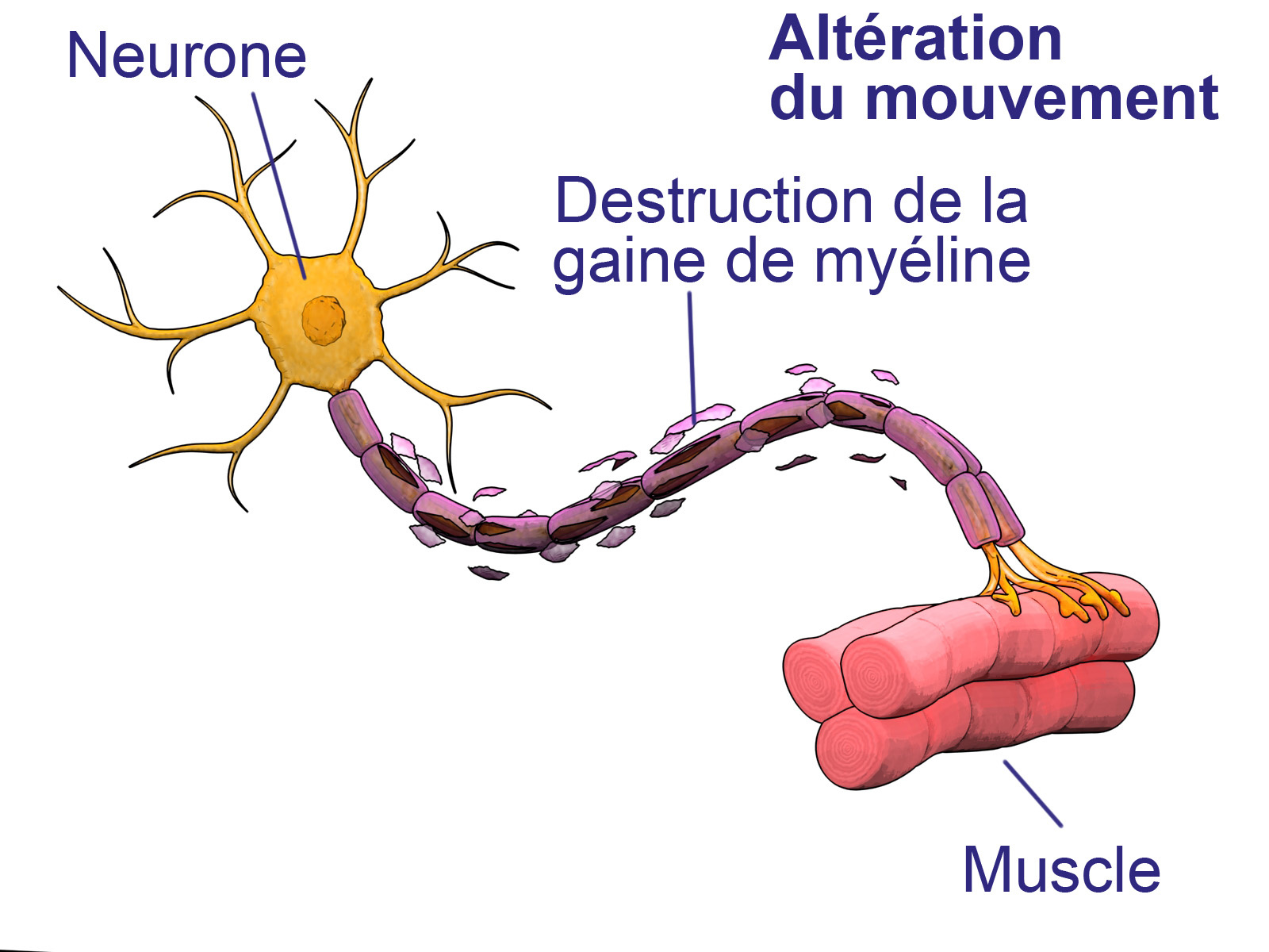 Sclérose en plaques : la sclérose en plaques